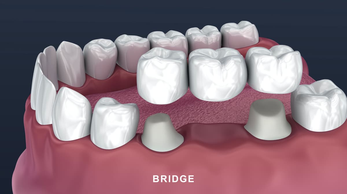 Dental bridge restoration