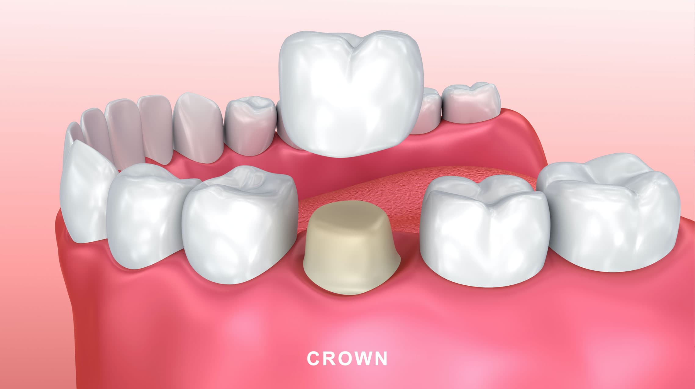 Dental crown restoration