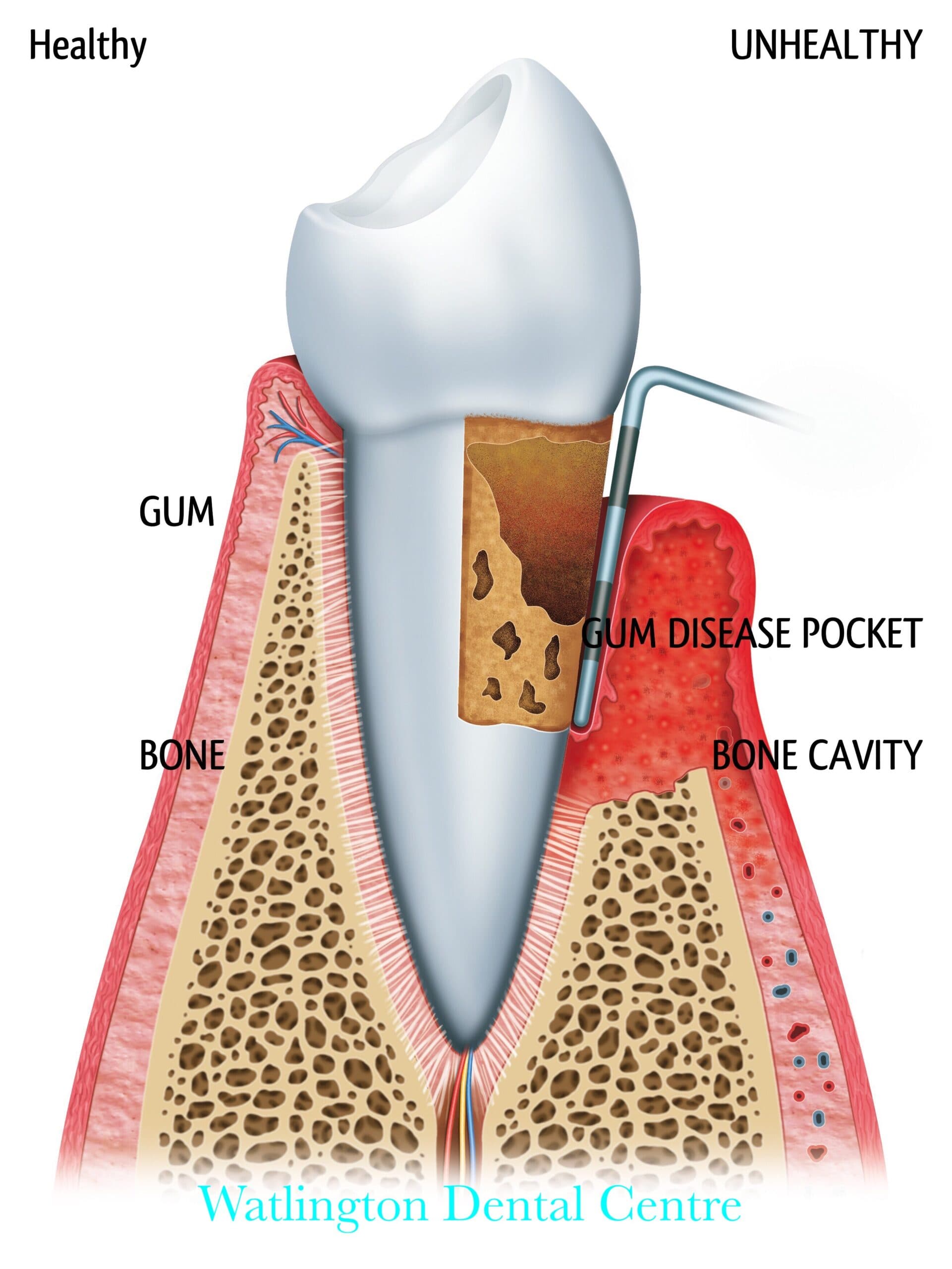 Healthy gums treatment