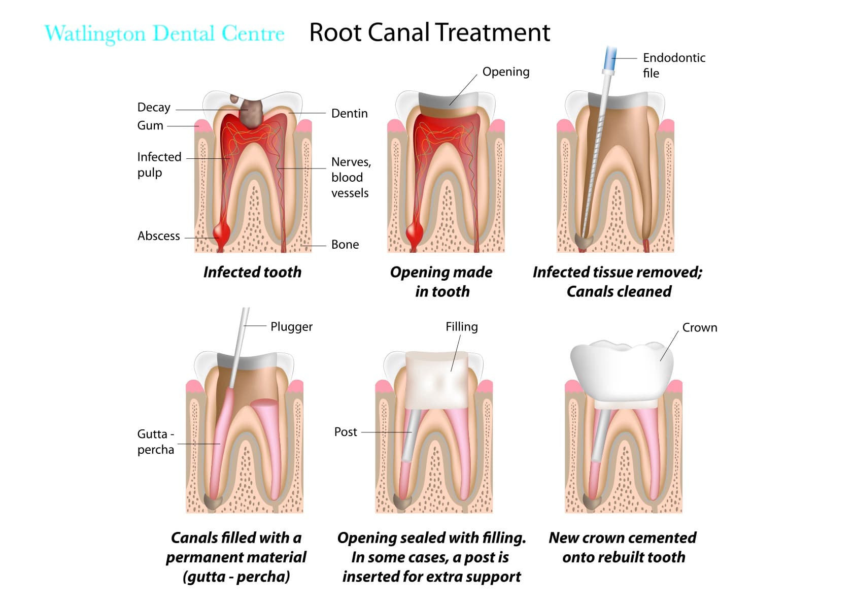Root canal treatment procedure