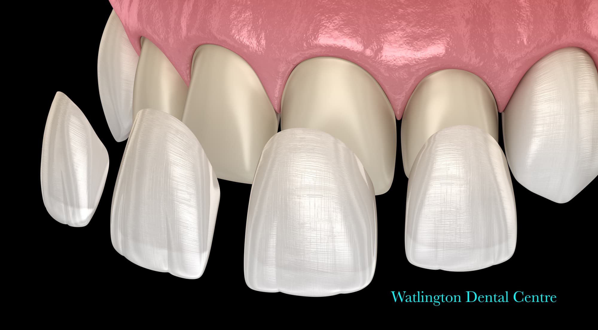 Beautiful smile with porcelain veneers