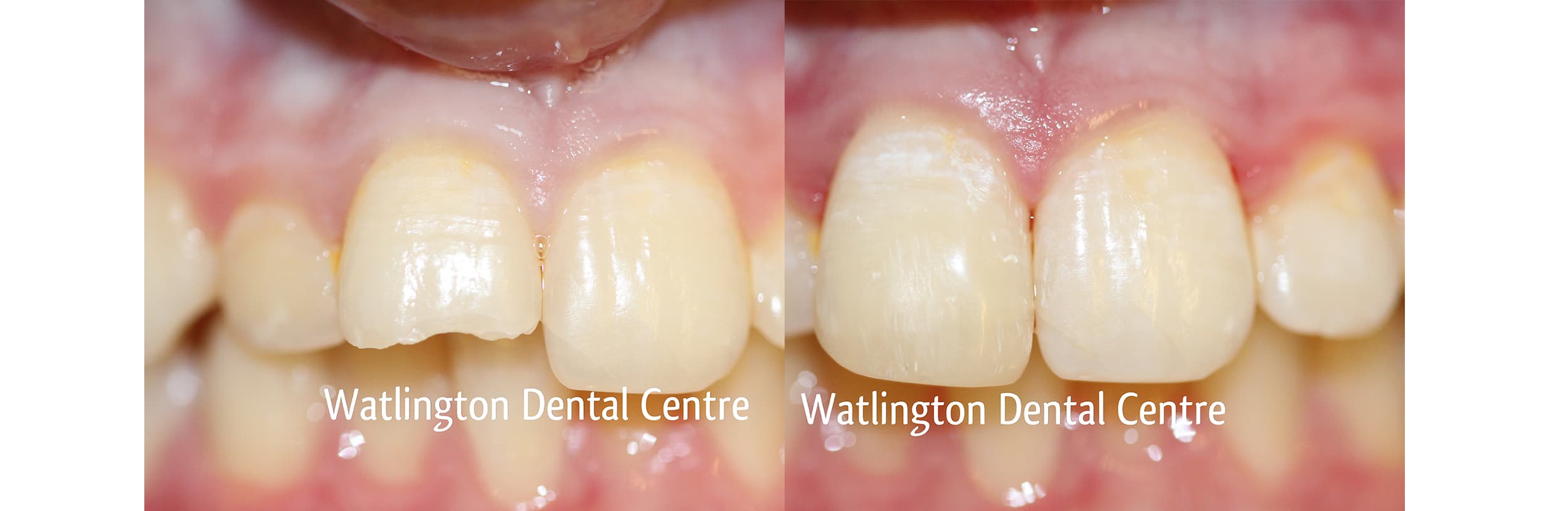 White composite filling treatment