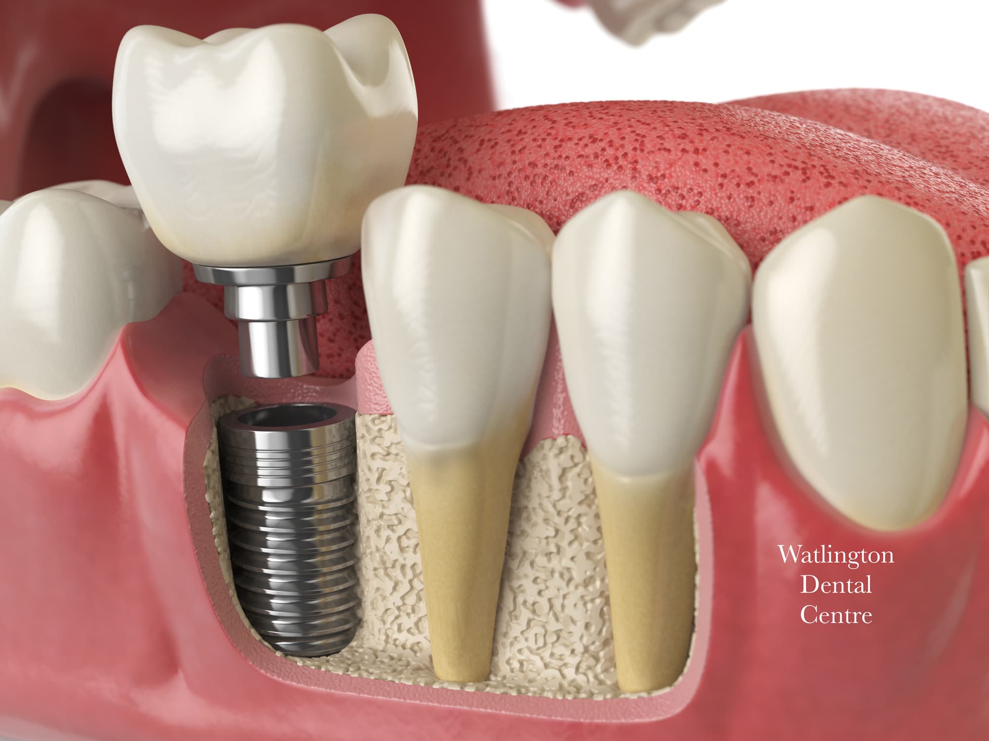 Dental implant procedure