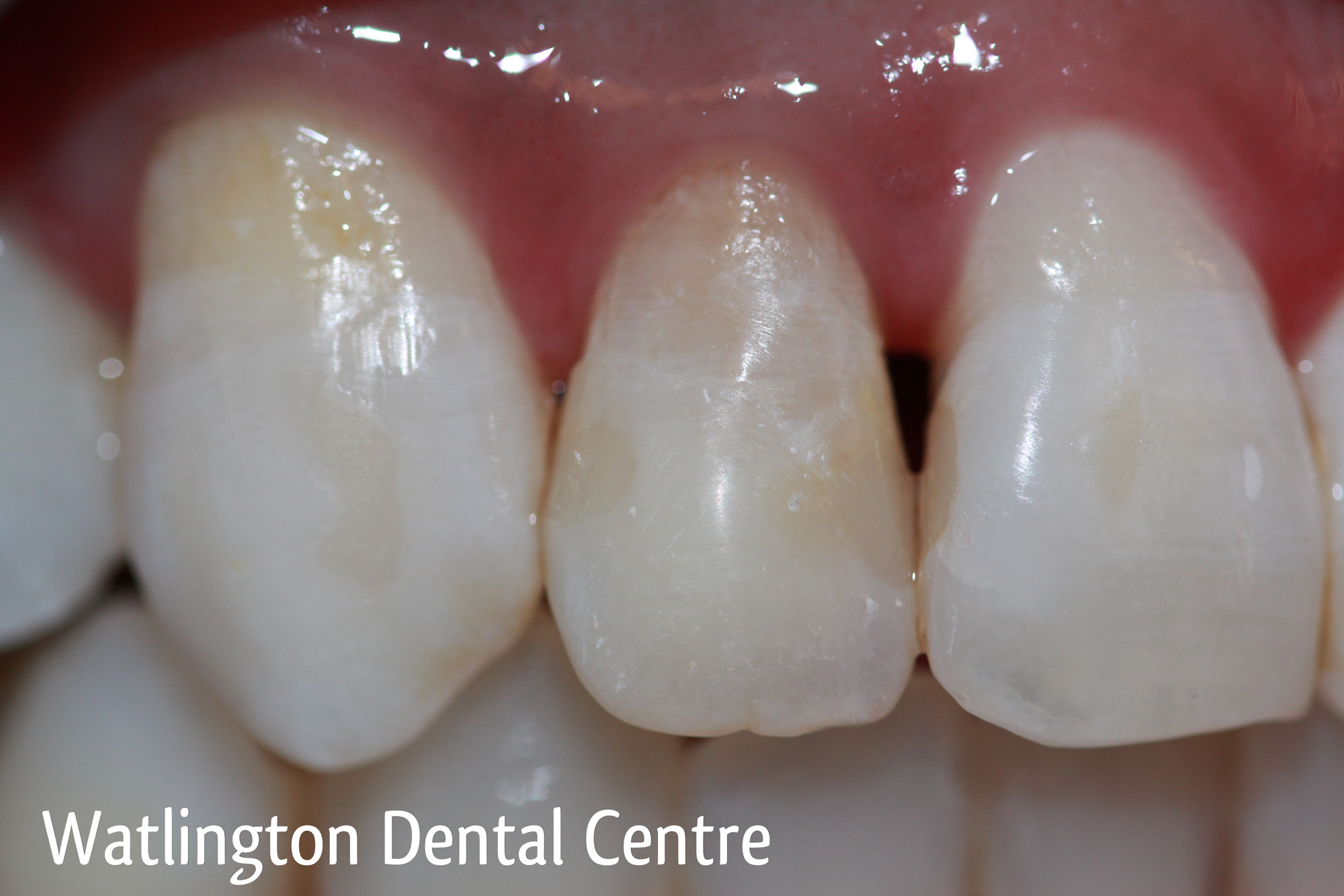 Teeth after whitening